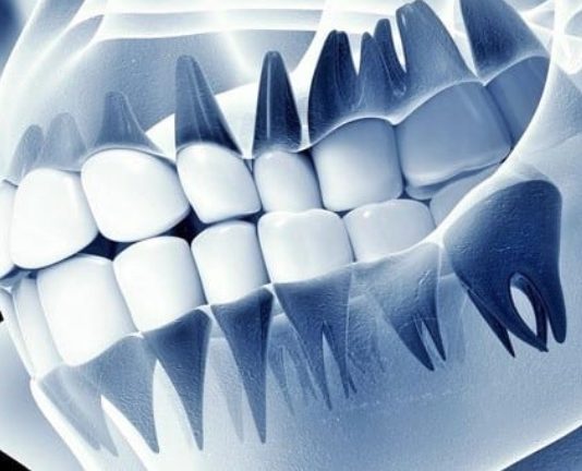 ฟันปลอมอัจฉริยะ “เชื่อมสมอง” ได้จริง นักวิทย์พัฒนาเทคโนโลยีรากฟันเทียมที่รู้สึกได้เหมือนฟันจริง