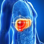 TARE ทางเลือกใหม่รักษามะเร็งตับ ฉีดสารกัมมันตรังสีตรงเข้าก้อนมะเร็ง ช่วยลดขนาดก้อนมะเร็ง เพิ่มโอกาสรอดโดยไม่ต้องผ่าตัด