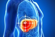 TARE ทางเลือกใหม่รักษามะเร็งตับ ฉีดสารกัมมันตรังสีตรงเข้าก้อนมะเร็ง ช่วยลดขนาดก้อนมะเร็ง เพิ่มโอกาสรอดโดยไม่ต้องผ่าตัด