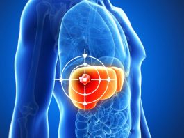 TARE ทางเลือกใหม่รักษามะเร็งตับ ฉีดสารกัมมันตรังสีตรงเข้าก้อนมะเร็ง ช่วยลดขนาดก้อนมะเร็ง เพิ่มโอกาสรอดโดยไม่ต้องผ่าตัด