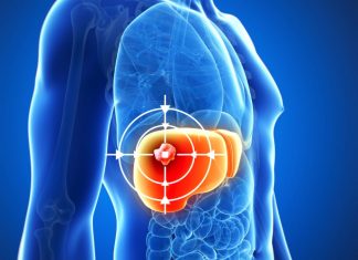 TARE ทางเลือกใหม่รักษามะเร็งตับ ฉีดสารกัมมันตรังสีตรงเข้าก้อนมะเร็ง ช่วยลดขนาดก้อนมะเร็ง เพิ่มโอกาสรอดโดยไม่ต้องผ่าตัด