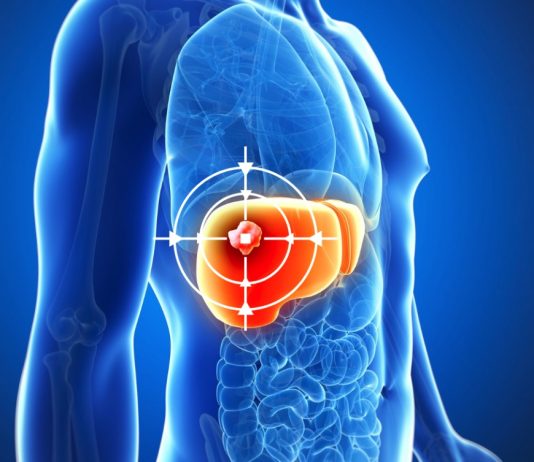 TARE ทางเลือกใหม่รักษามะเร็งตับ ฉีดสารกัมมันตรังสีตรงเข้าก้อนมะเร็ง ช่วยลดขนาดก้อนมะเร็ง เพิ่มโอกาสรอดโดยไม่ต้องผ่าตัด