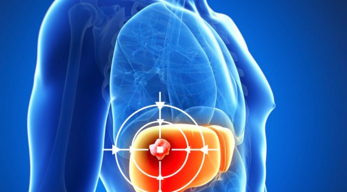 TARE ทางเลือกใหม่รักษามะเร็งตับ ฉีดสารกัมมันตรังสีตรงเข้าก้อนมะเร็ง ช่วยลดขนาดก้อนมะเร็ง เพิ่มโอกาสรอดโดยไม่ต้องผ่าตัด