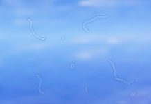 จุดลอยในตา (Eye Floaters) สัญญาณเตือนอันตรายไม่ควรมองข้าม สิ่งที่ควรรู้เพื่อป้องกันภาวะแทรกซ้อน