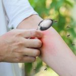 เคล็ดลับหน้าฝน ลดบวม ลดคันจากยุงกัดแบบปลอดภัย ด้วยใช้ช้อนอุ่นนาบจุดที่ยุงกัด