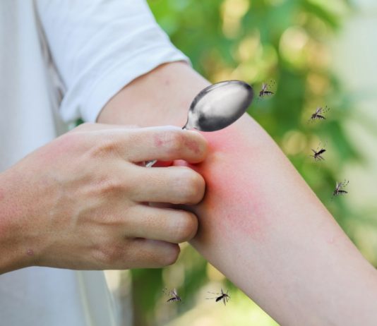 เคล็ดลับหน้าฝน ลดบวม ลดคันจากยุงกัดแบบปลอดภัย ด้วยใช้ช้อนอุ่นนาบจุดที่ยุงกัด