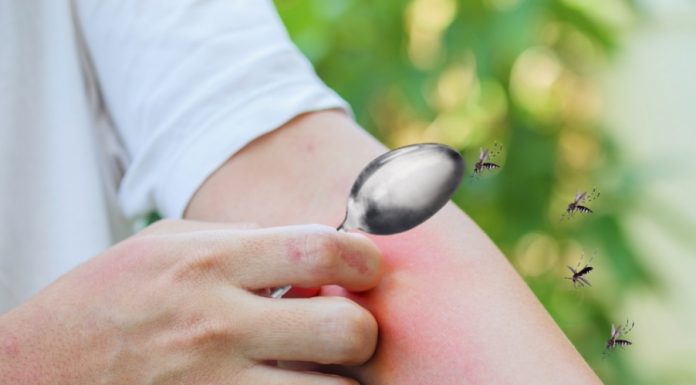 เคล็ดลับหน้าฝน ลดบวม ลดคันจากยุงกัดแบบปลอดภัย ด้วยใช้ช้อนอุ่นนาบจุดที่ยุงกัด